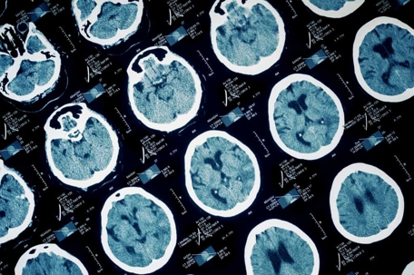 Close up of brain scan imaging